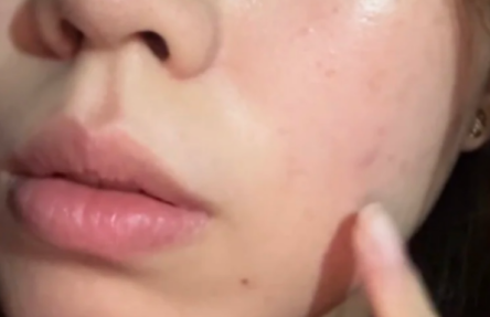脸上长了好多痘还有包该怎么去除呢？(图1)